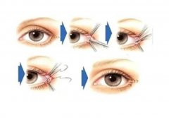 做双眼皮疼吗?做双眼皮之后有什么消肿的方法?