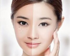 一次激光美白的价格，激光美白成果明显吗？