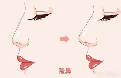 孙晓捷做鼻子怎么样？医生综合实力如何？内附隆鼻手术成果