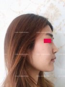 吸脂后脂肪少了，皮肤会不会变得很松啊？(吸脂和瘦脸脂，可以一起做吗？)