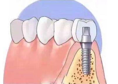 延安大学附属医院口腔科医生哪个好？艾延安、高朵朵，种植牙实例