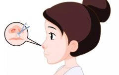 中山三院颜玲怎么样？附坐诊时间|技术点评|鼻综合实例