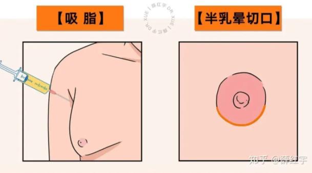 是怎么做乳房缩小手术的？手术的详细步骤