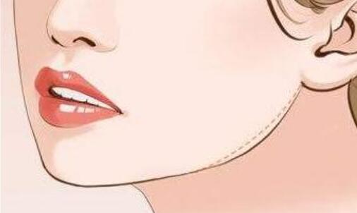 l下颌角q2.jpg l下颌角q2.jpg