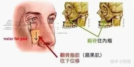 颧骨变小的方法有哪些?怎么让颧骨变小?