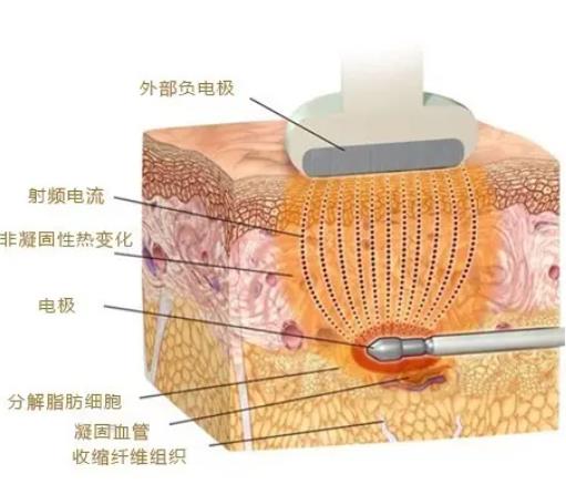 射频紧肤有没有效?瘦肚子怎么样？