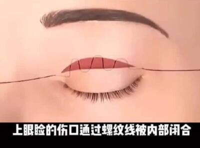 曾繁茂做双眼皮怎么样？手术风格真人实例都在这儿