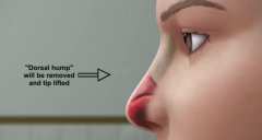 上海隆鼻失败修复手术技术不错的医生有哪些?医生排名+真人实例图