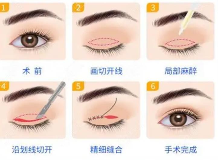 眼睑下垂有哪些原因?
