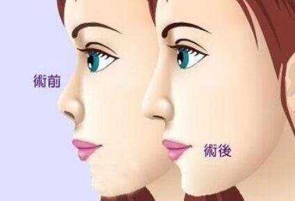 隆鼻动漫21.jpg 隆鼻动漫21.jpg