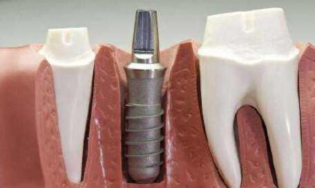 QQ截图20190820132242.jpg 白银市第一人民医院口腔科曹秀怎么样?医生简介+种植牙实例