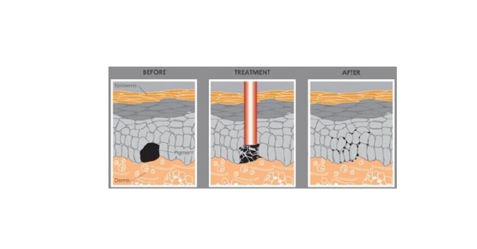 激光祛疤.jpg 激光祛疤.jpg