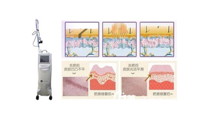 祛疤.jpg 祛疤.jpg