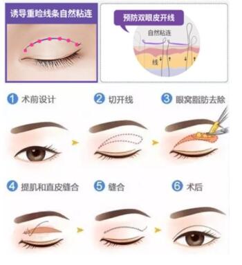 孙熙东眼睛整形实例作品：保守自然中透着一点韩式俏皮美