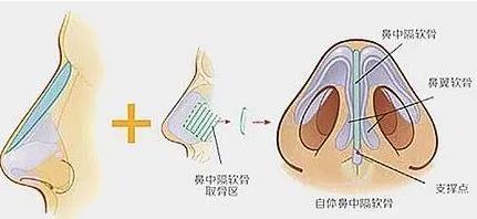 李文信医生做鼻子怎么样？隆鼻风格怎么样？隆鼻手术案例