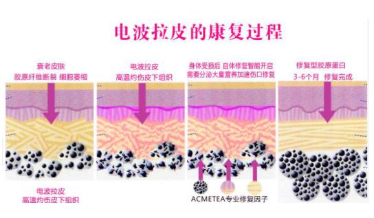 什么样的人适合电波拉皮，电波拉皮的原理是什么?