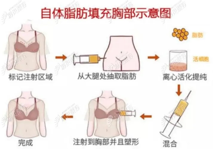 自体丰胸的原理是什么，有什么好处?
