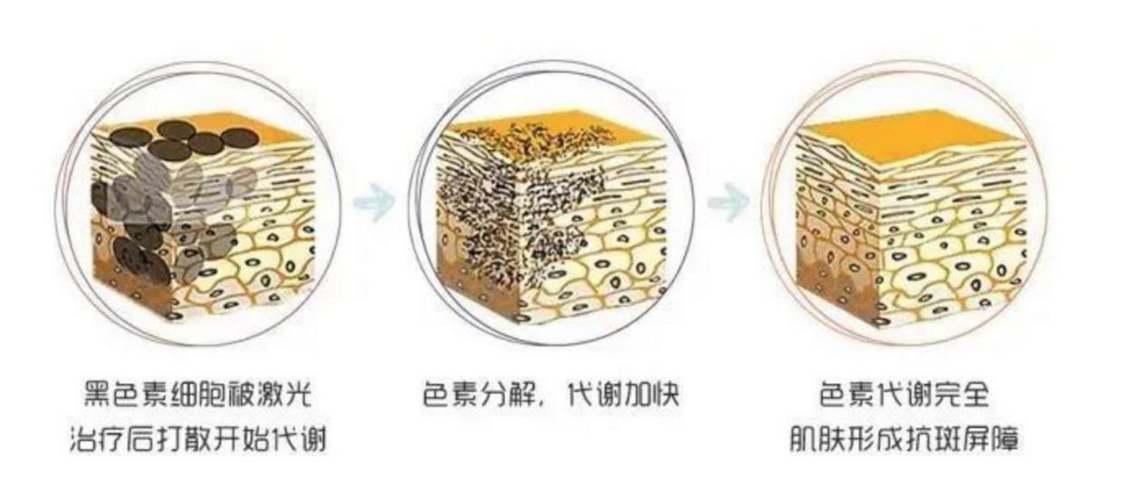 超皮秒祛斑.jpg