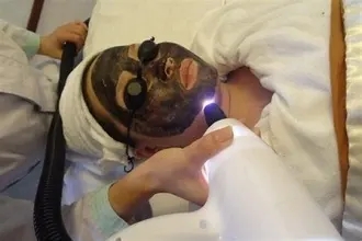 黑脸娃娃和光子嫩肤的区别是什么？