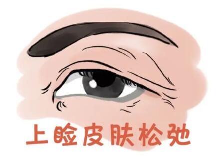 上眼皮松弛怎么办？有什么好的矫正方法？你有同样的烦恼吗？