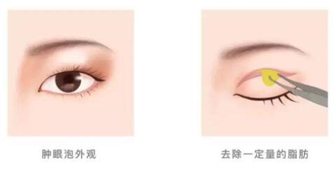全切双眼皮有肉条用什么办法消除？这几招学起来让你轻松变美~