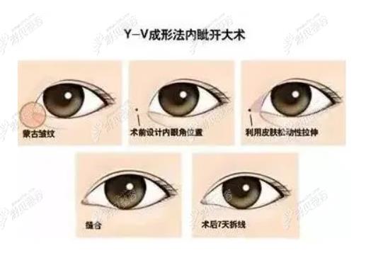 开内眼角的价格受什么影响呢?