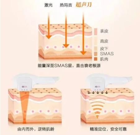 超声刀有哪些副作用和风险？