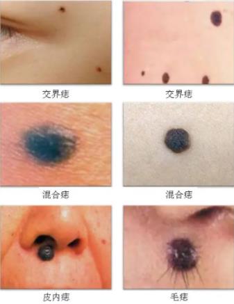 激光祛疤成果怎么样?需要注意什么?