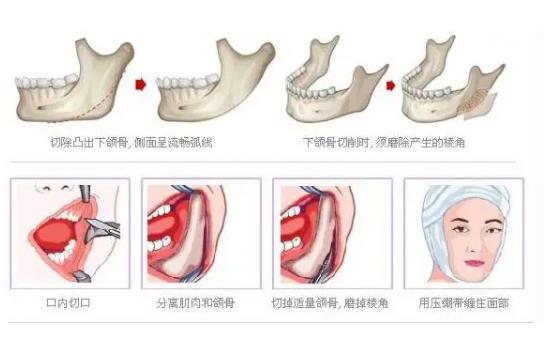 劈外板和磨外板有什么区别？劈外板侧面脸型会改变吗?