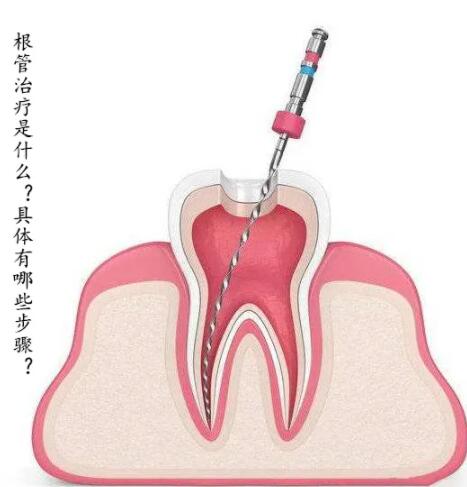 根管治疗多少钱一颗牙？什么原因影响了治疗的价格？治疗流程详解