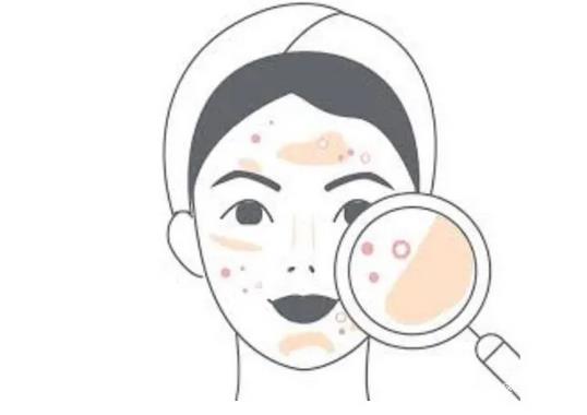 微信截图_20220420184738.jpg 激光去除痘印安好性怎么样?