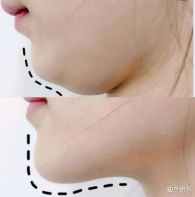 双下巴溶脂多久能修复？术后注意事项