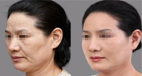 光子嫩肤美肤怎么样