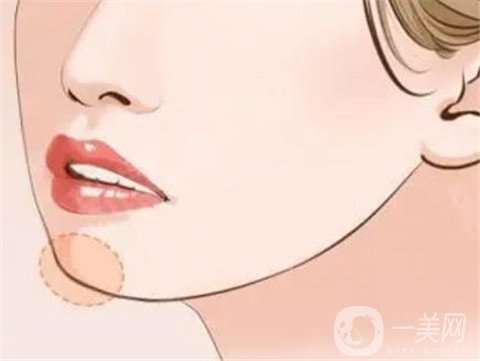 注射玻尿酸丰下巴有哪些优点？