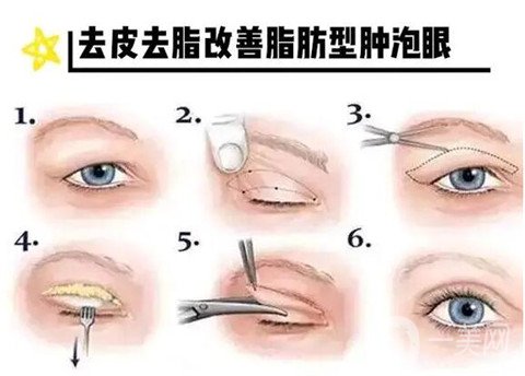 肿泡眼有哪些分类？肿泡眼的类型有哪些