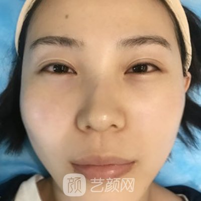 武汉康美莱医疗美容医院好不好？除皱嫩肤实例及成果图公布