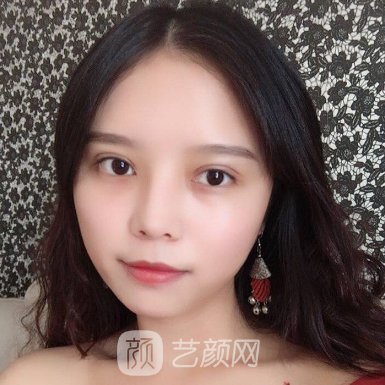 武汉伊莱美整形医院怎么样？2022双眼皮招牌实例一览