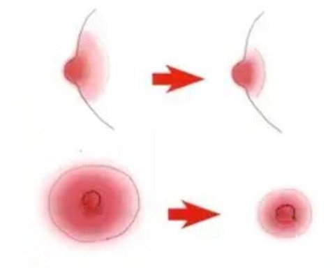 乳晕缩小手术的成果怎么样呢？