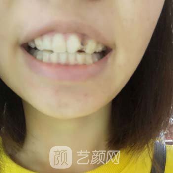 徐州市第一人民医院牙齿矫正价格贵吗？多少钱？附实例