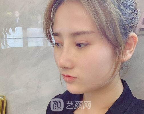 珠海人民医院割双眼皮怎么样?90天亲身体验实例公布