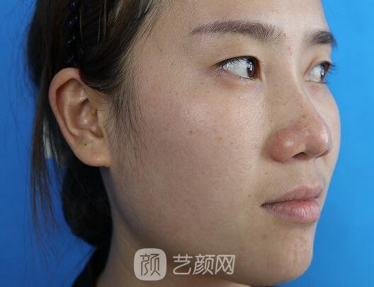 珠海人民医院割双眼皮怎么样?90天亲身体验实例公布