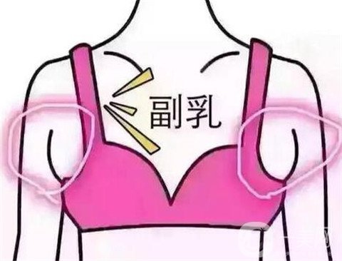副乳切除术有什么风险？