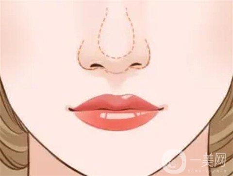 鼻头缩小后会导致增生出现吗？