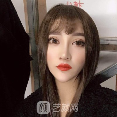 长沙华韩华美医疗美容医院光子嫩肤正规吗？2022案例分享