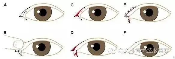 开眼角有哪些方式？开眼角要忌口多久?