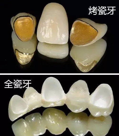 烤瓷牙是什么做的，有什么特点?