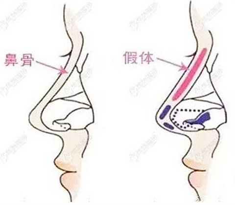 哪些因素影响玻尿酸隆鼻的维持时间？