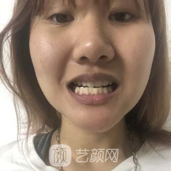 阜宁县人民医院戴云龙牙齿种植案例鉴赏，恢复正常口腔状态
