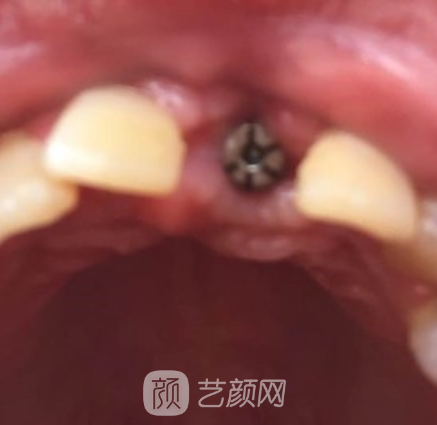 重庆牙管家口腔医院怎么样？种植牙案例及效果图展示
