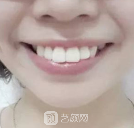 重庆牙管家口腔医院怎么样？种植牙案例及效果图展示